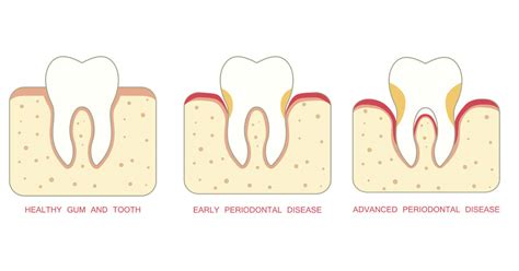 5 Natural Ways To Keep Your Gums Healthy And Disease Free