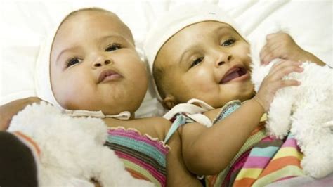 Separating Conjoined Twins Rital And Ritag The Journey Bbc News