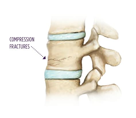 Vertebral Compression Fracture Summit Orthopedics