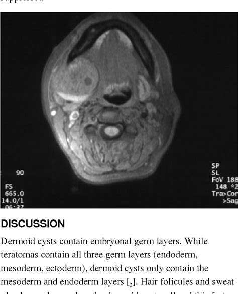 Figure 4 From A Rare Case Of Dermoid Cyst Originating From The