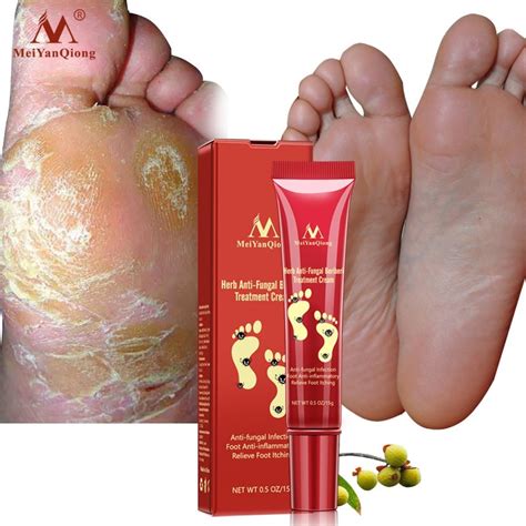 Foot Cream Anti Fungal Foot Care Treatment Skin Care Anti Fungal Foot