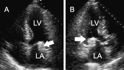 Caseous Calcification Of The Mitral Valve Ring Heart Lung And