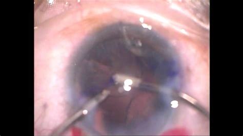 cataract surgery and toric intraocular lens implantation by dr uday gadgil youtube