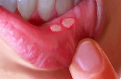 Everything You Need To Know About Mouth Ulcers