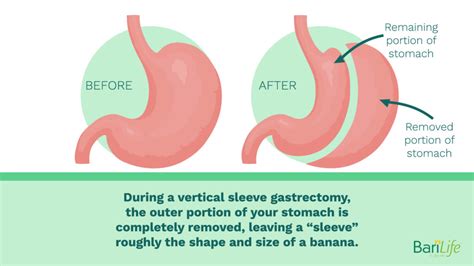 Gastric Sleeve Before And After Stomach How To Know When You Need A Gastric Bypass Surgery