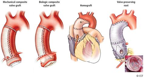 Aortic Replacement In Cardiac Surgery Cleveland Clinic Journal Of
