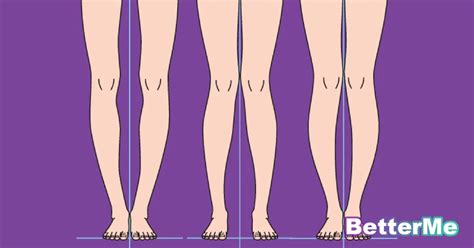 how to straighten bow legs in adults without surgery exercises for bow legs correction bow