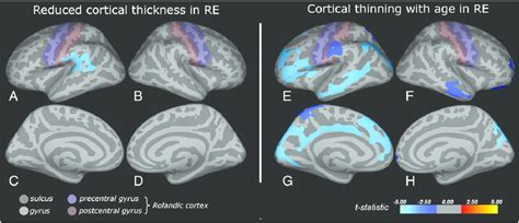 Cortical Abnormalities In Rolandic Epilepsy Inflated Brain