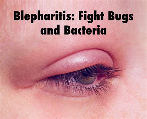 Blepharitis Fight Bugs And Bacteria Blepharitis Itchy Eyelids