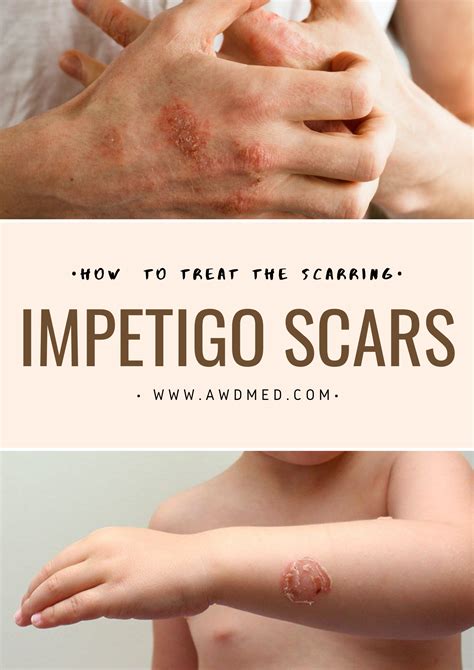 Pin On How To Get Rid Of Scars