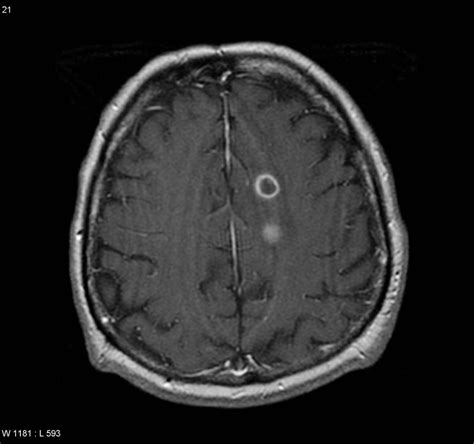 Brain Abscess Differential Diagnosis Wikidoc