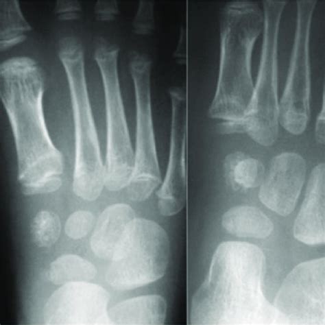 Fracture Of The Medial Cuneiform And Lisfranc Joint Were Reduced And