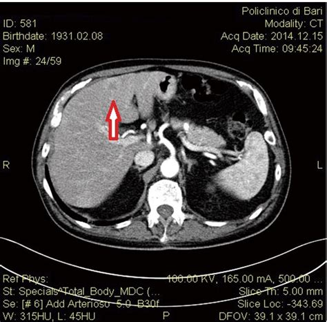 Abdominal Ct Scan Showing An Hypodense Solid Lesion In The Liver