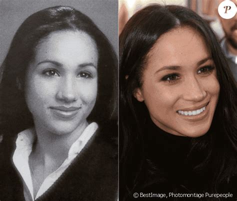 Meghan Markle Before And After Plastic Surgery