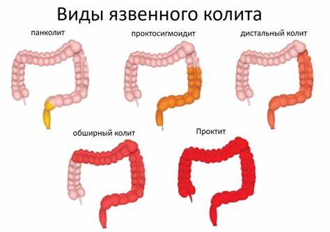 Диета язвенного колита кишечника Лечение язвенного колита в Германии — Симптомы, диагностика и методы Лечение язвенного колита в Германии — Симптомы, диагностика и методы Диета язвенного колита кишечника
