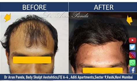 Hair Transplant In Navi Mumbai Dr Arun Panda