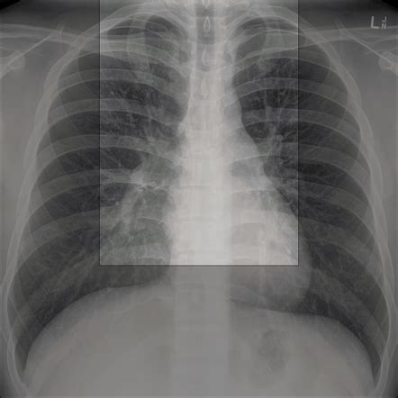 Abcde Chest X Ray Sexiz Pix