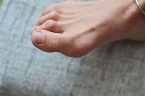 What Is Hammer Toe