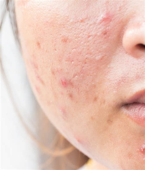 Acne And Acne Scarring Treatments Mesa Az Sagebrush Dermatology