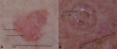 Cutaneous Squamous Cell Carcinoma Journal Of The American Academy Of