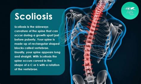 Scoliosis Treatment Causes Symptoms And Surgery Article Articleted