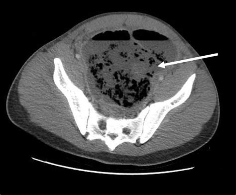 Axial Contrast Enhanced Ct Abdomen And Pelvis Of The Patient At Third