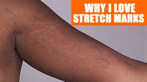 Love Your Stretch Marks Youtube