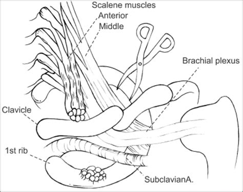 These include cervical plexus, brachial plexus, lumbar plexus, and sacral plexus. Schematic diagram of a supraclavicular scalenectomy. Af ...