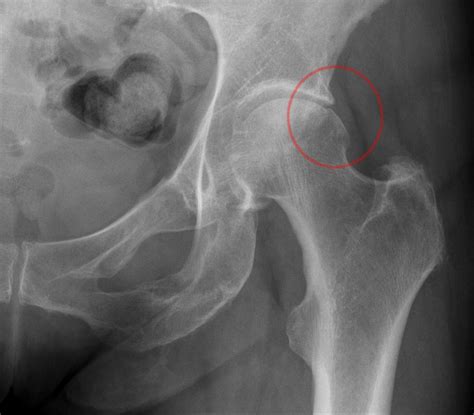 Hip Impingement What Is It And How Do We Treat It