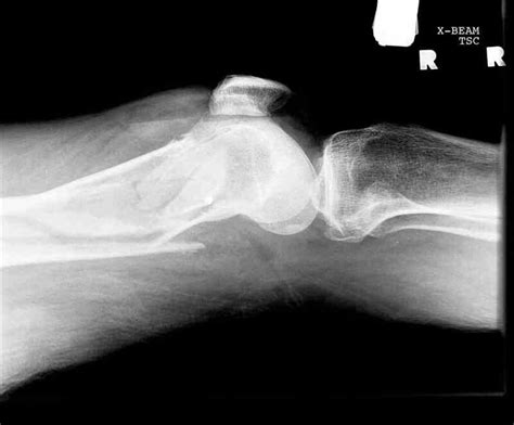 Figure Lateral Knee Radiograph Fracture With Lipohemarthrosis