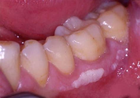 Leukoplakia Causes The Best And 1 Way To Prevent Leukoplakia