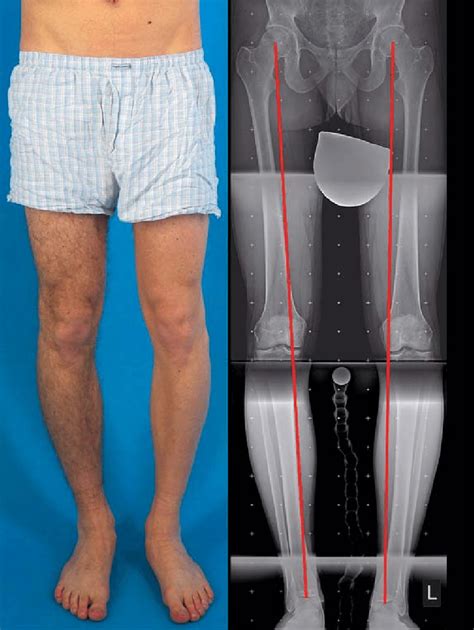 Bilateral Varus Deformity Of The Leg Axis Resulting From Malalignment
