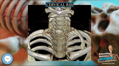 Cervical Rib 🦴 Everything Human Anatomy Bones 🦴 Youtube