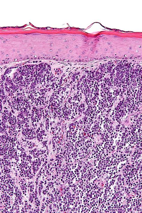 Merkel Cell Carcinoma Libre Pathology