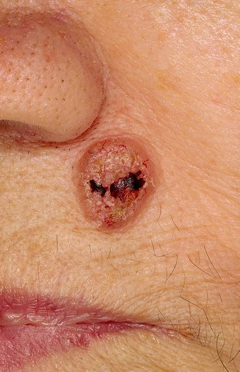 Skin Cancer On Face Pictures 33 Photos And Images