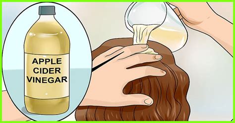 12 Best Home Remedies To Improve Scalp Psoriasis Effectively