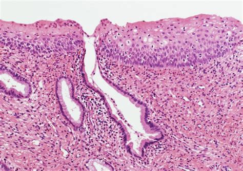 Escamoso Glandular Metaplasico é Grave