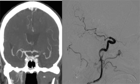 Acute Intracranial Internal Carotid Artery Occlusion Extension And