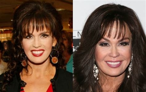 Marie Osmond Before And After Plastic Surgery 15 Celebrity Plastic
