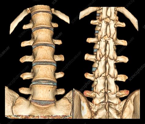 Normal Spine 3d Ct Scans Stock Image C0252577 Science Photo Library