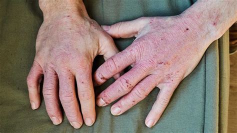 Vesicular Hand Dermatitis Causes Symptoms And Treatment