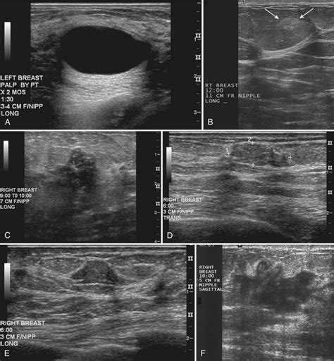 Breast Ultrasound Radiology Key