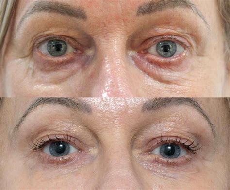 Best Tixel Eye Rejuvenation Brisbane Cutis Dermatology