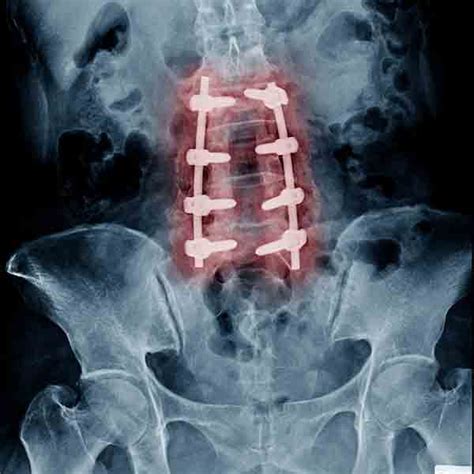 Minimally Invasive Spine Surgery Nj Champey Pain Spine