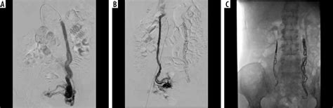 Efficacy Of The Endovascular Ovarian Vein Embolization Technique In