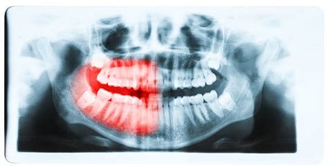 20 Closeup X Ray Of Impacted Wisdom Tooth Stock Photos Pictures