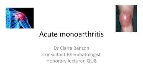 Acute Monoarthritis Acute Monoarthritis Dr Claire Benson Consultant