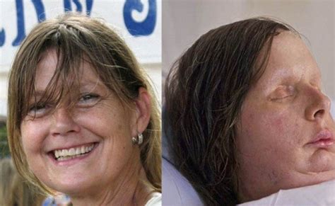 Charla Nash Wins 4m After Chimpanzee Ripped Her Face Off Ibtimes Uk