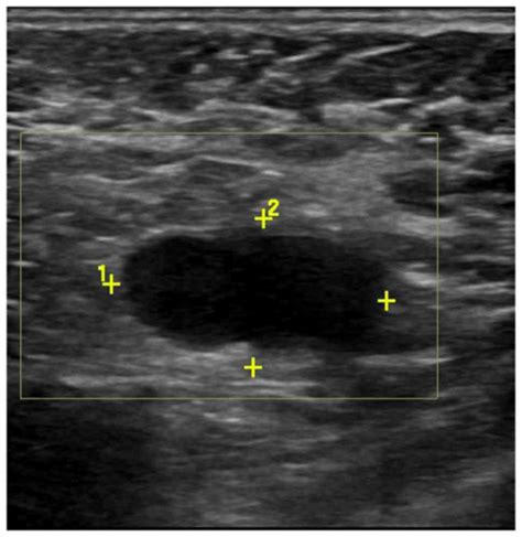 Malignant Axillary Lymph Nodes Ultrasound