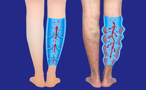 Leg Swelling Lymphedema Or Chronic Venous Insufficiency
